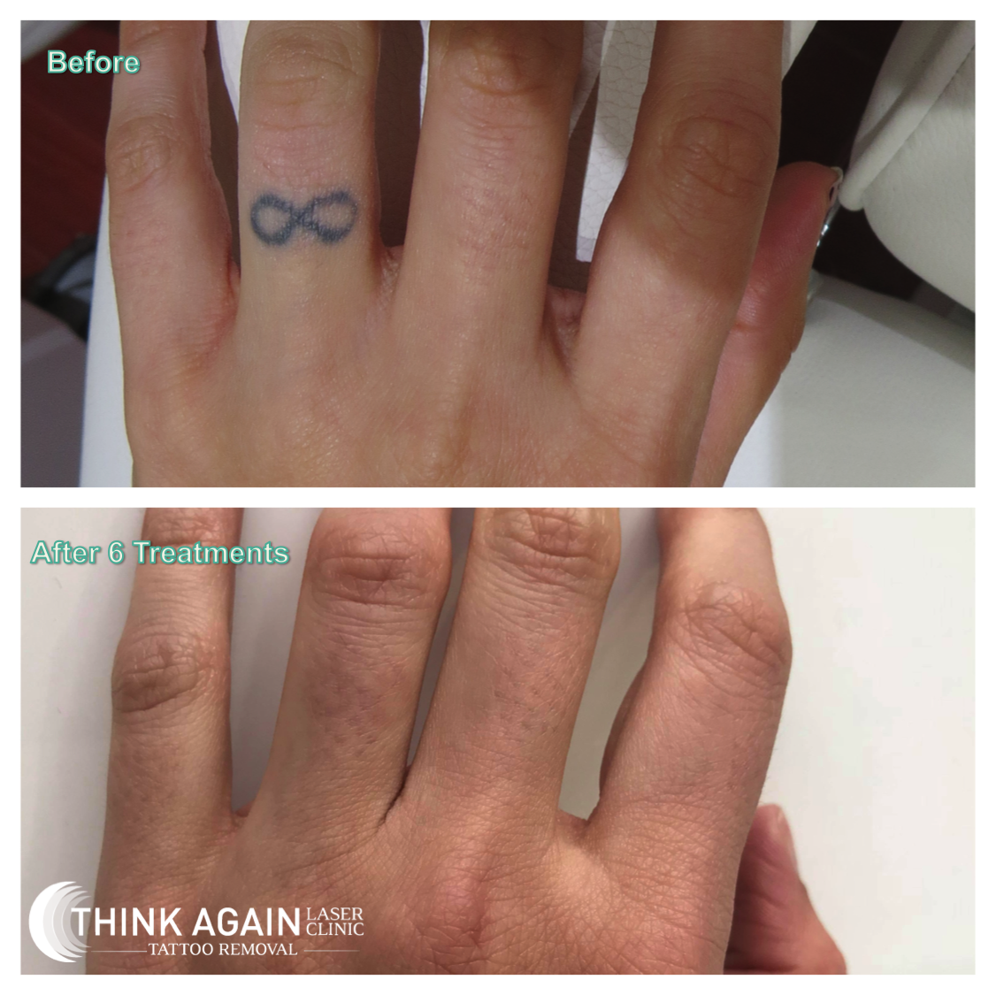 Tattoo Removal Before and After Photos | Goodbye Tattoos