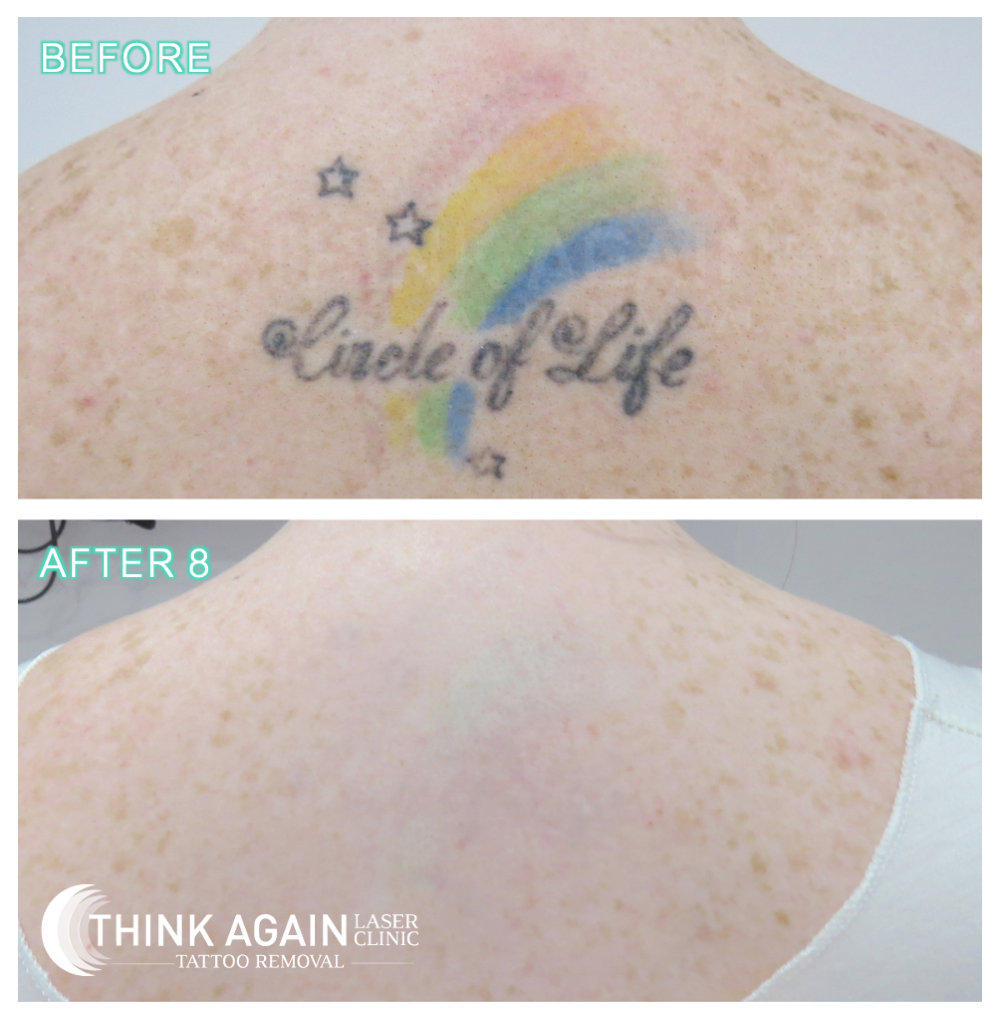 Laser Treatment For Tattoo Removal at Best Cost