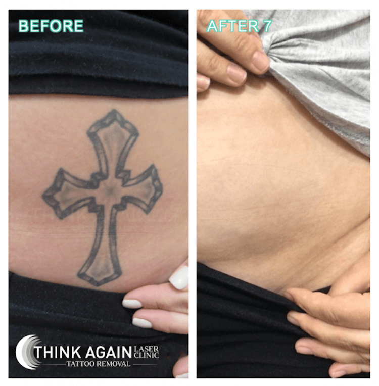 Top Rated Auckland Laser Tattoo Removal Clinic // Free Consults // Think  Again Laser Clinic ______ Auckland Tattoo Removal // Think Again Laser  Clinics ______ Laser Tattoo Removal // Think Again Laser