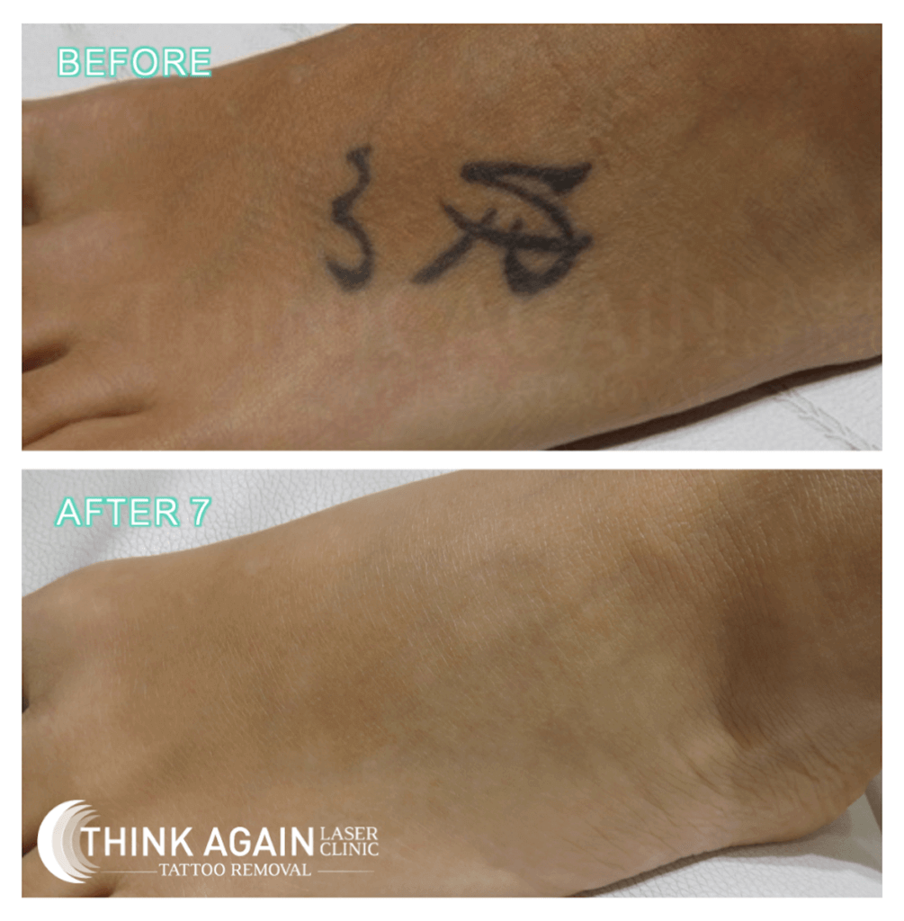 Laser Tattoo Removal  Removal or Lightening  Powerhouse Tattoos