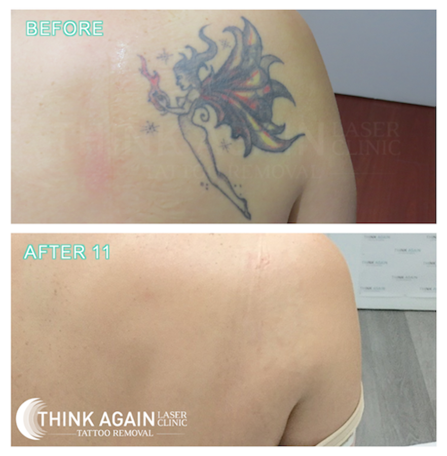Removery Laser Tattoo Removal (@removery) | TikTok
